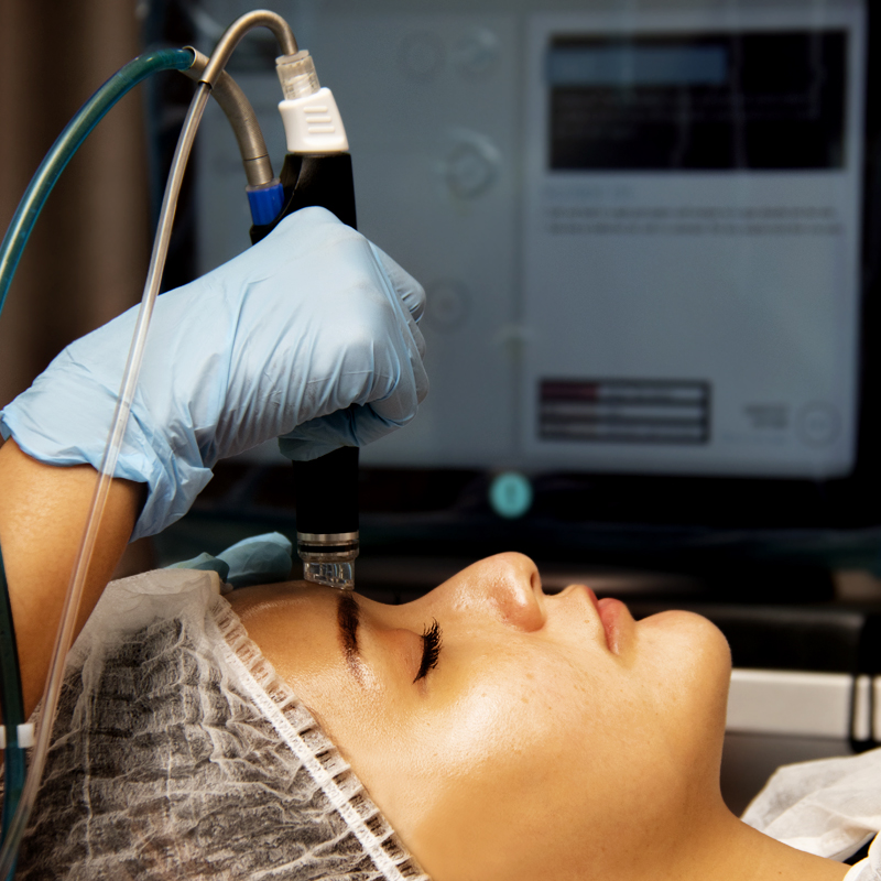 Hydrafacial Deluxe Acne - Face